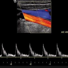 Arterie e vene degli arti superiori