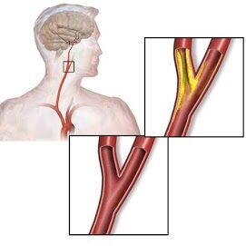 stenosi carotidea